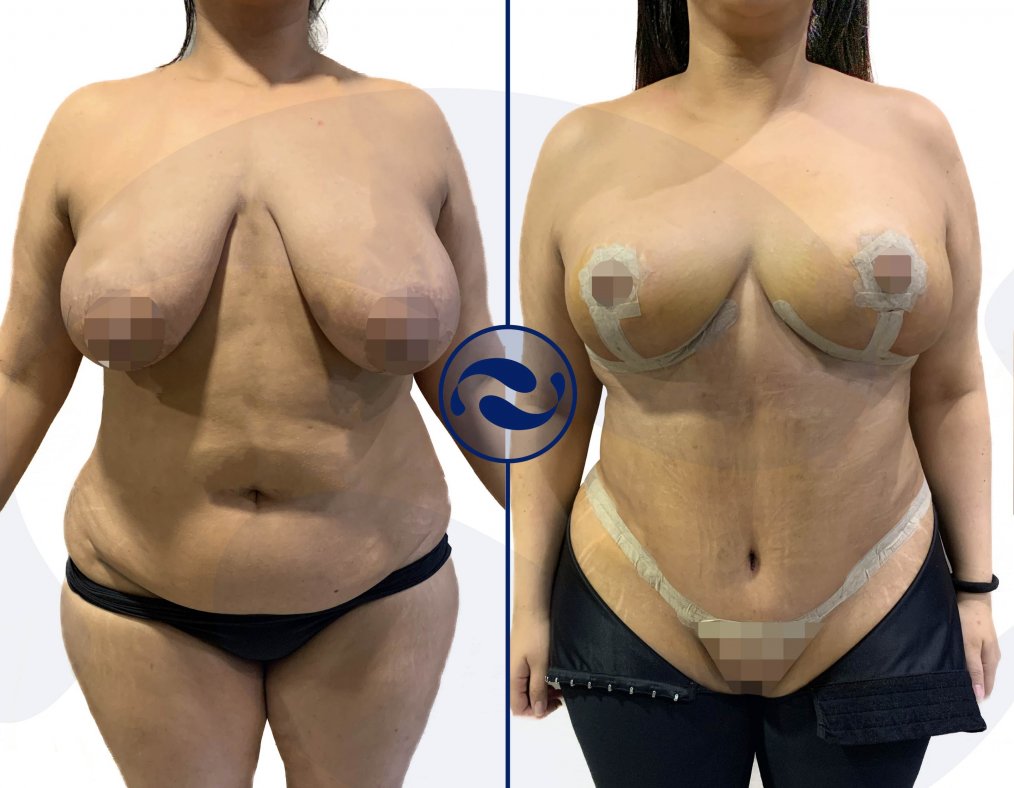 Sydney Breast Lift after Pregnancy - Mommy Makeover